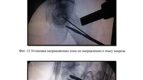 Что такое депозит шейки бедренной кости